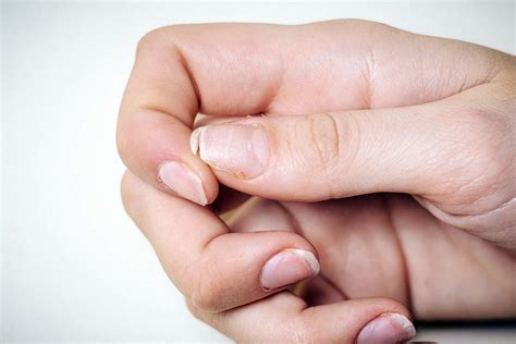 Treating Peeling Nails Causes Prevention And Treatment