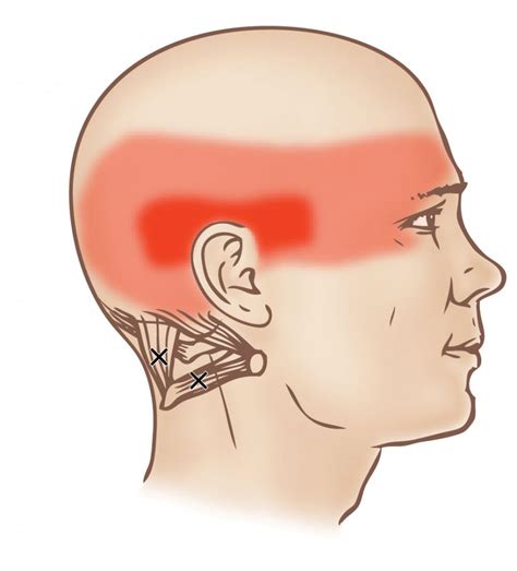 Suboccipital Group Trigger Point Learn Muscles