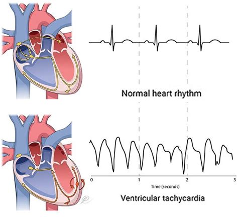 Right Ventricular Tachycardia