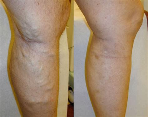 Tips To Prevent And Reduce Or Eliminate Varicose Veins