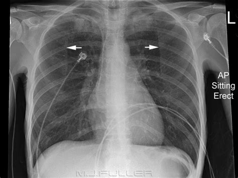 Notes On Chest Radiography Wikiradiography
