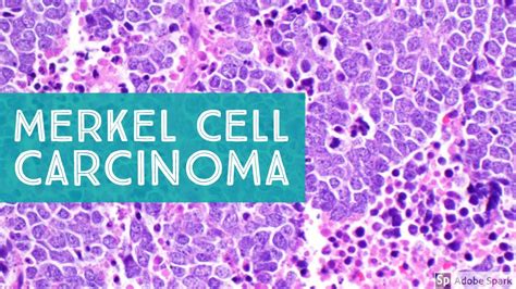 Merkel Cell Carcinoma 101 Primary Cutaneous Neuroendocrine Carcinoma