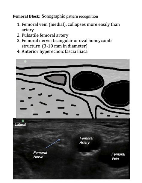Femoral — Highland Em Ultrasound Fueled Pain Management