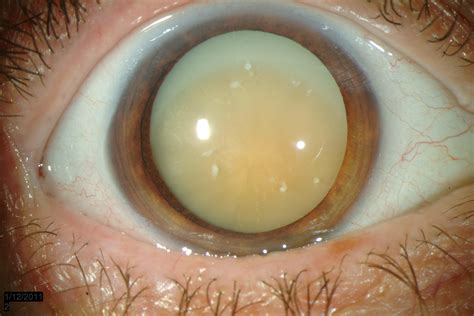 This cloudiness can cause a decrease in vision and may lead to eventual blindness if left untreated. Morgagnian Cataract. EyeRounds.org - Ophthalmology - The ...