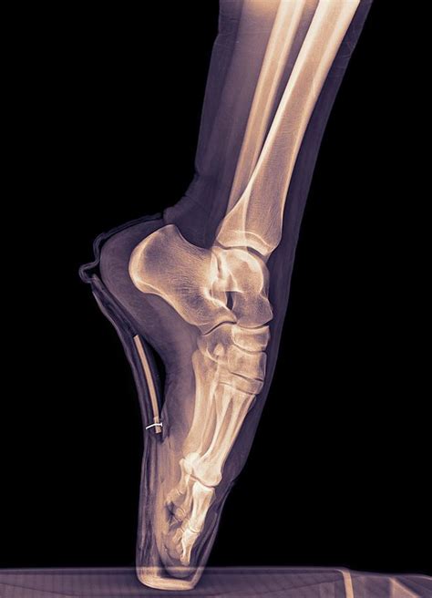 Ballet Dancer X Ray Photograph By Photostock Israel