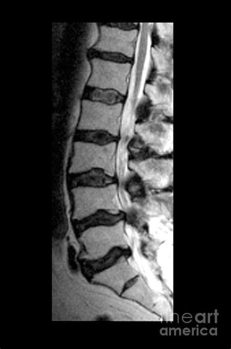 Severe Facet Joint Degeneration Photograph By Medical Body Scans