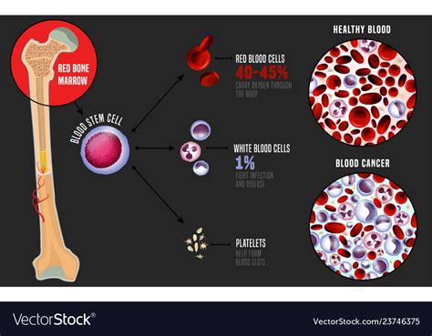 Leukemia Medical Infographic Royalty Free Vector Image