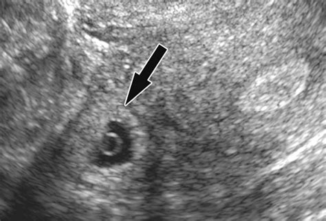 Vaginal Ultrasound Showing Gestational Sac With Yolk Sac In Extra My Xxx Hot Girl