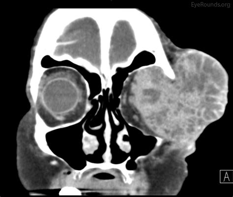 Adenoid Cystic Carcinoma Of The Lacrimal Gland