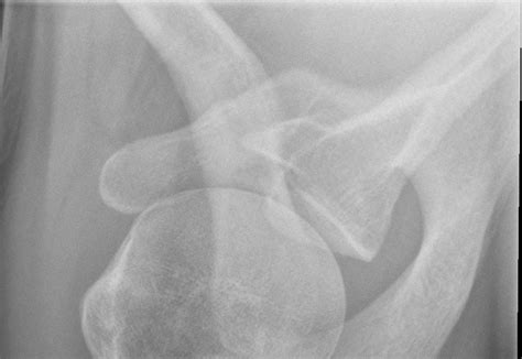 Glenoid Fracture Treatment Glenoid Bone Fracture Surgery