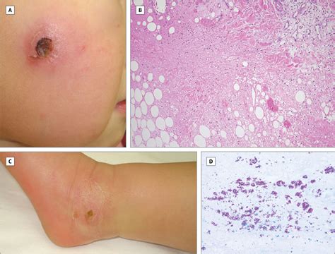 If left untreated, buruli ulcer can result in. Buruli Ulcer Caused by Mycobacterium ulcerans ...