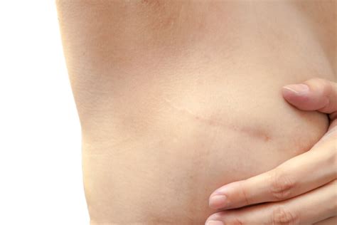 Mastectomy Why Its Done Options For Breast Reconstruction