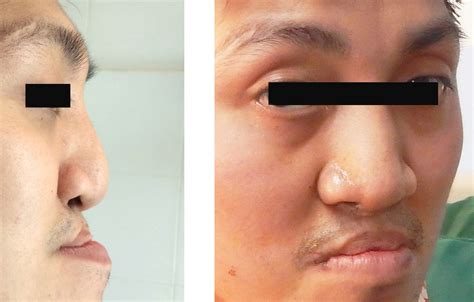 Plastic Surgery Before And After Photos Cleft Nose Rhinoplasty