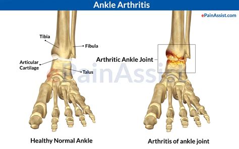 Ankle Joint Arthritiscausessymptomstreatment Nsaids Opioids Pt