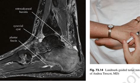 The muscle that removes the big toe (m.abductor hallucis) lies superficially along the medial edge of the foot. 13 STIR MRI sagittal image of the ankle showing retrocalcaneal... | Download Scientific Diagram