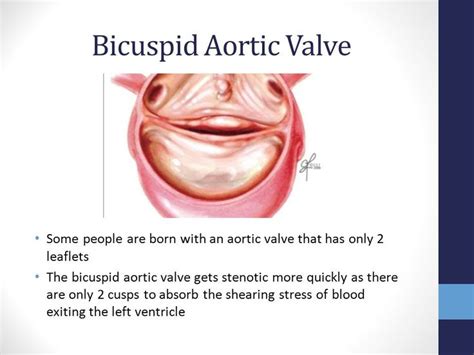 32 Best Images About Bicuspid Aortic Valve On Pinterest