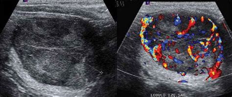 Abnormal Thyroid Cancer Ultrasound Colors Katelynn Deluca