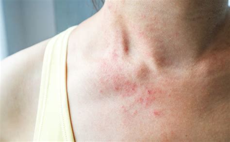 A New Symptom Of Coronavirus Appeared Skin Rash ⋆ Somag News