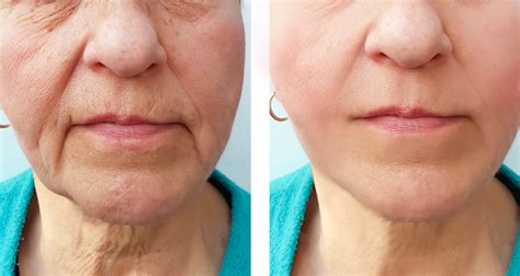 Ageless Before And After Image 6 Anti Age Naturally