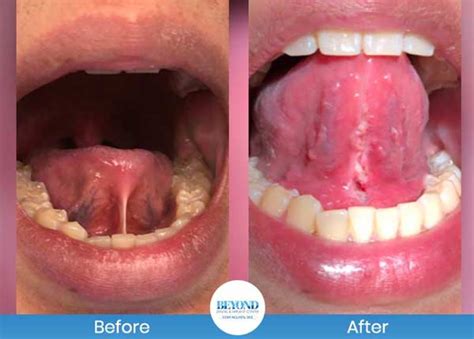 Tongue Tie Surgery Before And After Near Me In Dallas Tx And Fort Worth Tx