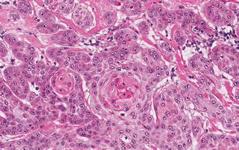 2 Moderately Differentiated Squamous Cell Carcinoma Showing Vesicular