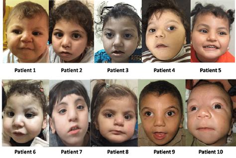 Facial Photos Of Our 10 Patients Note The Closed Distinct Facial