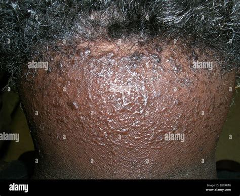 Acne Keloidalis Nuchae AKN In A Senior African American Male Patient AKN Is A Type Of