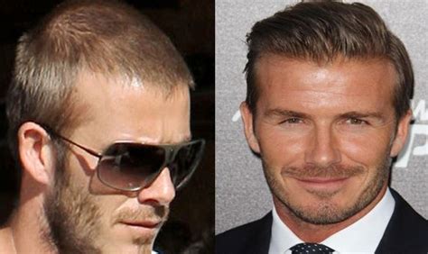 There Are A Lot Of Super Celebrities Who Have Had Hair Transplants Todays Super Celebrity