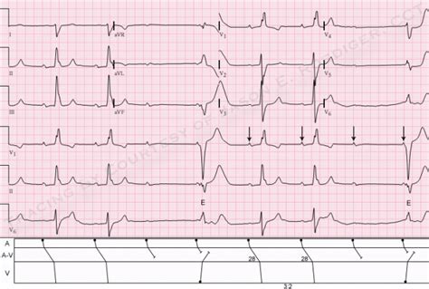 It also affects the qrs and t morphologies. Right axis deviation | ECG Guru - Instructor Resources
