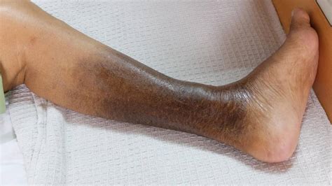 Leg Discoloration Imaging And Interventional Specialists