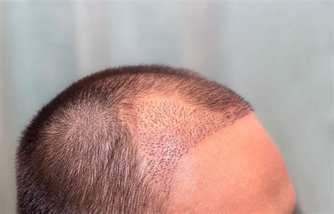 Shock Loss After Hair Transplantation Causes Duration And Solutions