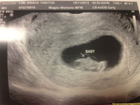 Ipregnant First Ultrasound At 8 Weeks 2 Days