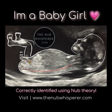 15 Week Ultrasound Baby Ultrasound Ultrasound Gender Prediction Baby