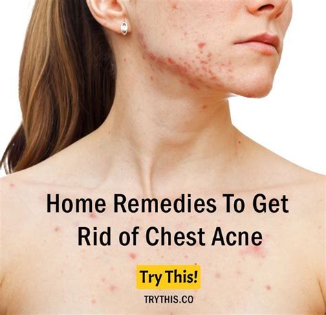 Home Remedies To Get Rid Of Chest Acne Home Remedies For Acne Chest