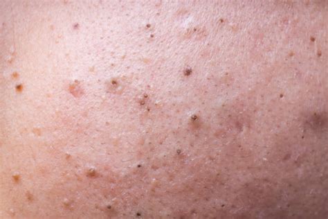 Blackheads On Inner Thighs Why They Occur And Possible Treatment
