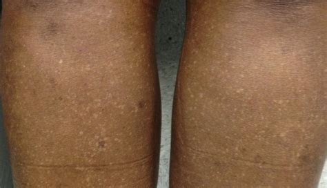 Barre Bas Marque Déposée White Spots On Legs Pictures Bière Hassy Mouette