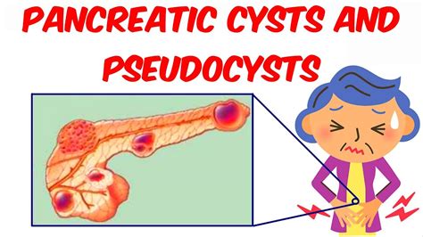 Pacreatic Cysts And Pancreatic Pseudocysts Youtube