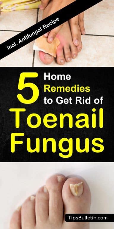 How To Get Rid Of Toenail Fungus 5 Home Remedies
