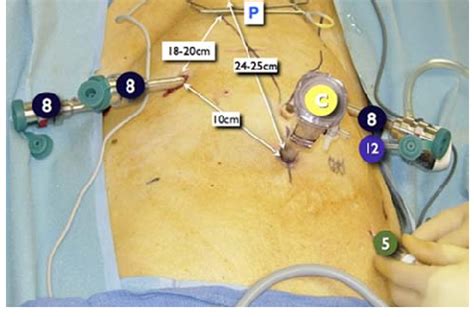 Port Placement During Robot Assisted Radical Cystectomy With Pelvic
