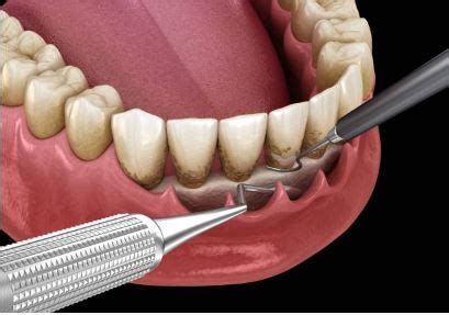 A Comprehensive Guide To Periodontal Scaling And Root Planing What You