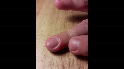 Gross Infected Fingernail Pop Youtube