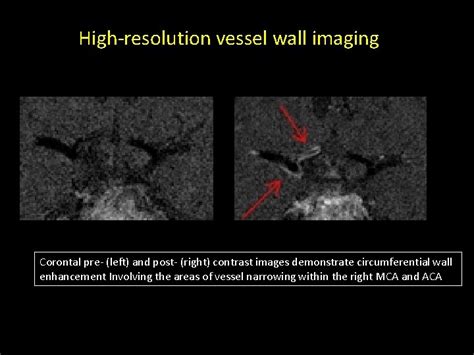 Highresolution Vessel Wall Mr Imaging Findings In Varizellazoster