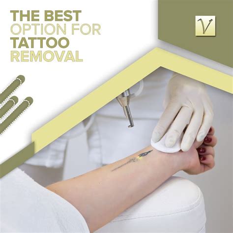 Laser Tattoo Removal Is The “gold Standard” Of Tattoo Removal Options