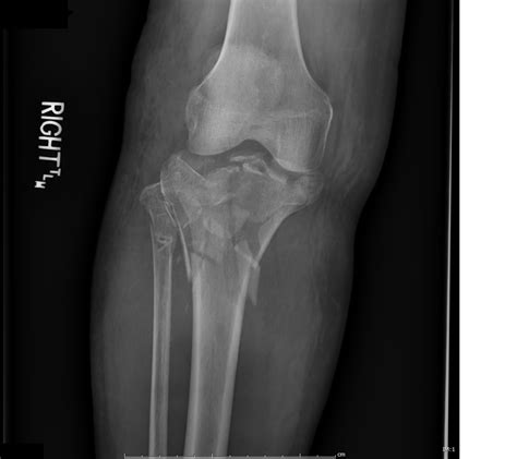 Left Bicondylar Tibial Plateau Fracture Icd 10