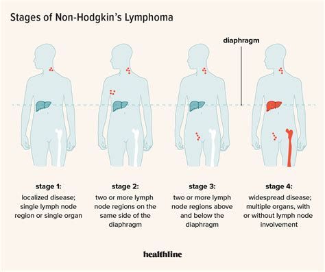 Non Hodgkin S Lymphoma Stages