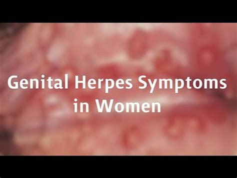 Genital Herpes Symptoms In Women Youtube