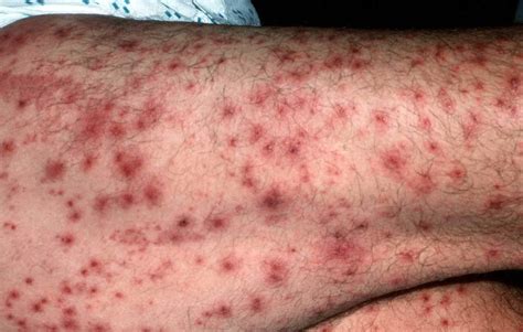 Leukocytoclastic Vasculitis Causes Symptoms Treatment