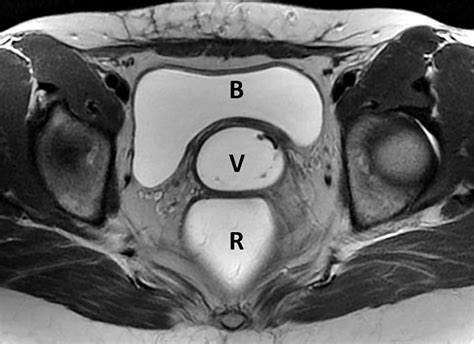 Translabial Us And Dynamic Mr Imaging Of The Pelvic Floor Normal