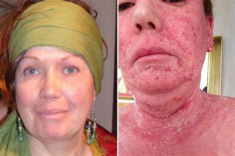 Graphic Pictures Reveal The Horror Of Eczema Sufferer Skinned Alive