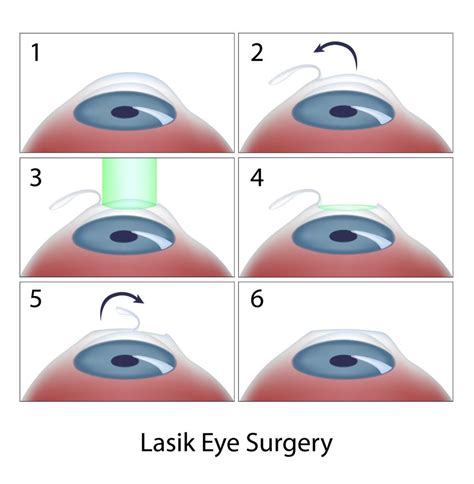 Different Types Of Eye Surgery That Can Change Your Life Style Vanity